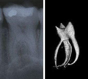 X-ray and MR image of a tooth